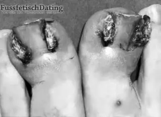 Eingewachsene Fußnägel mit viel Eiter Habe ich nicht sexy eingewachsene Fußnägel?